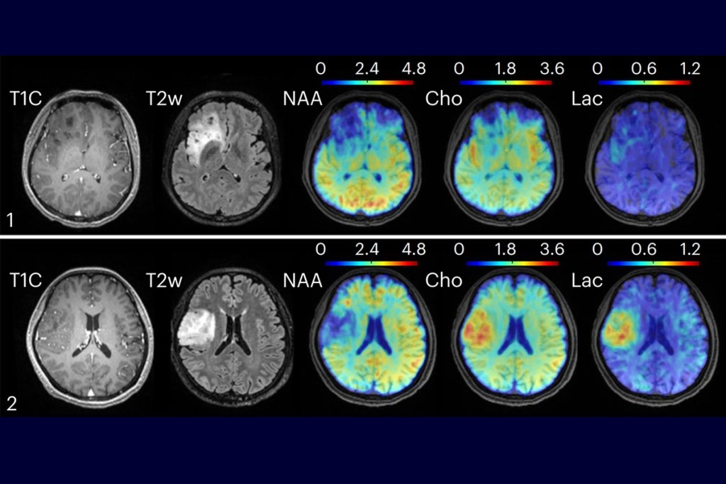 New technology combining high-speed MRI with machine learning methods for data processing found metabolic changes in oligodendroglioma brain tumors. Clinical MRI, in the left two columns, could not distinguish between tumors of grade II, top, and grade III, bottom. However, the new technique found elevated levels of choline and lactate in the grade III tumor. Image courtesy of Yibo Zhao