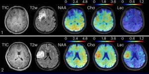 New technology combining high-speed MRI with machine learning methods for data processing found metabolic changes in oligodendroglioma brain tumors. Clinical MRI, in the left two columns, could not distinguish between tumors of grade II, top, and grade III, bottom. However, the new technique found elevated levels of choline and lactate in the grade III tumor. Image courtesy of Yibo Zhao